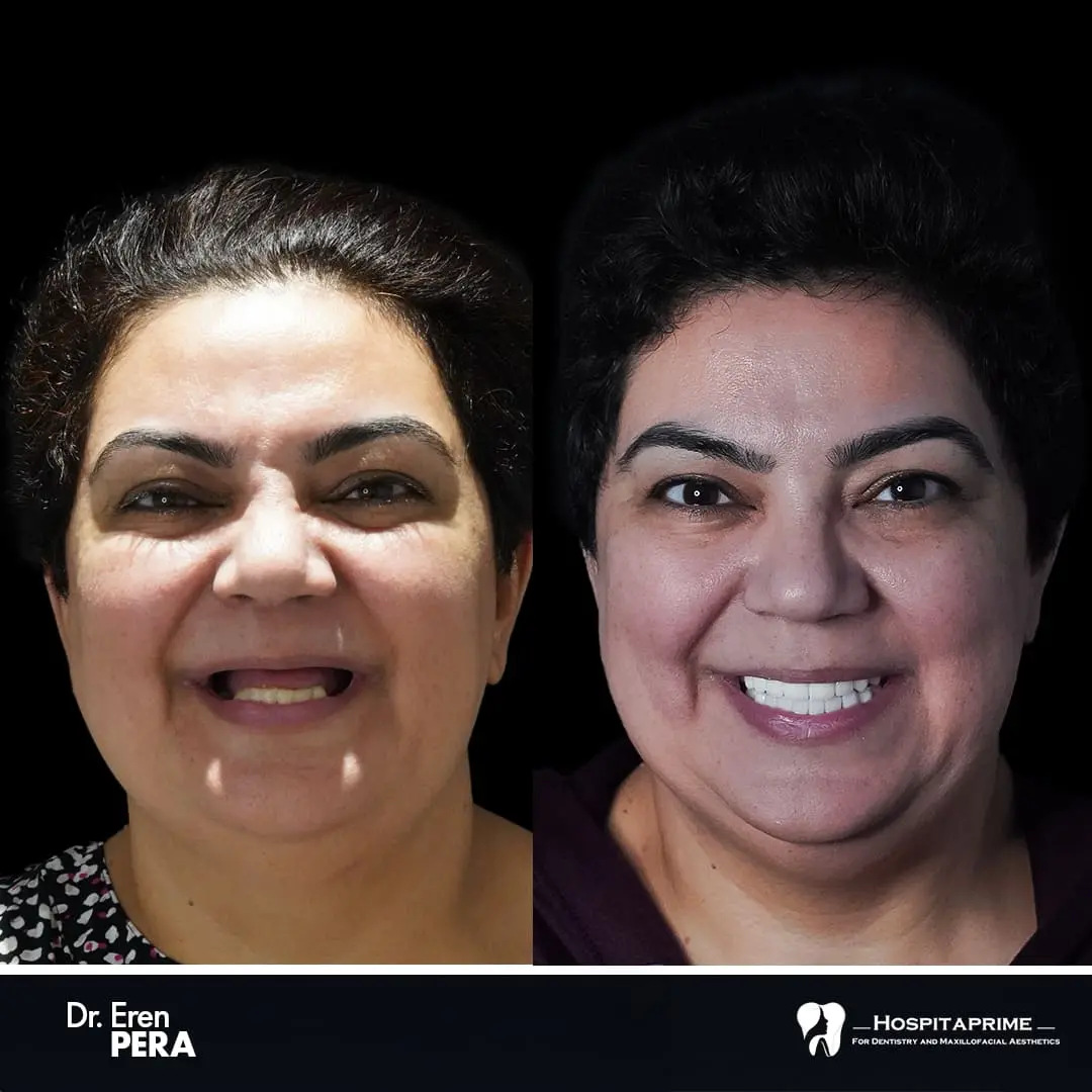 Low-price teeth implants in Turkey, before and after photo at Hospitaprime Clinic