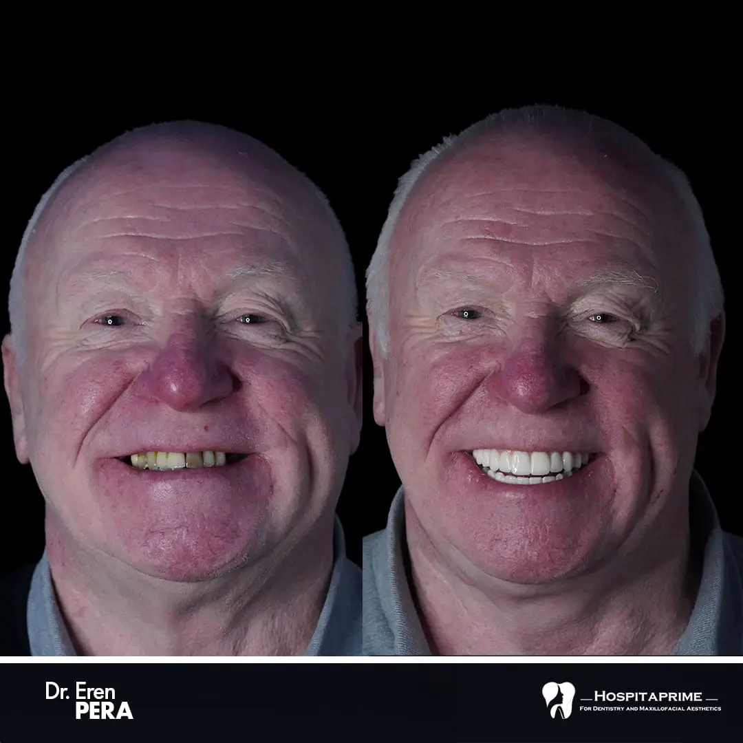 Cost-effective 3 on 6 dental implants transformation photo in Turkey at Hospitaprime Clinic
